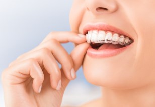 This is the image for the news article titled A Warning About Clear Aligners Seen On TV