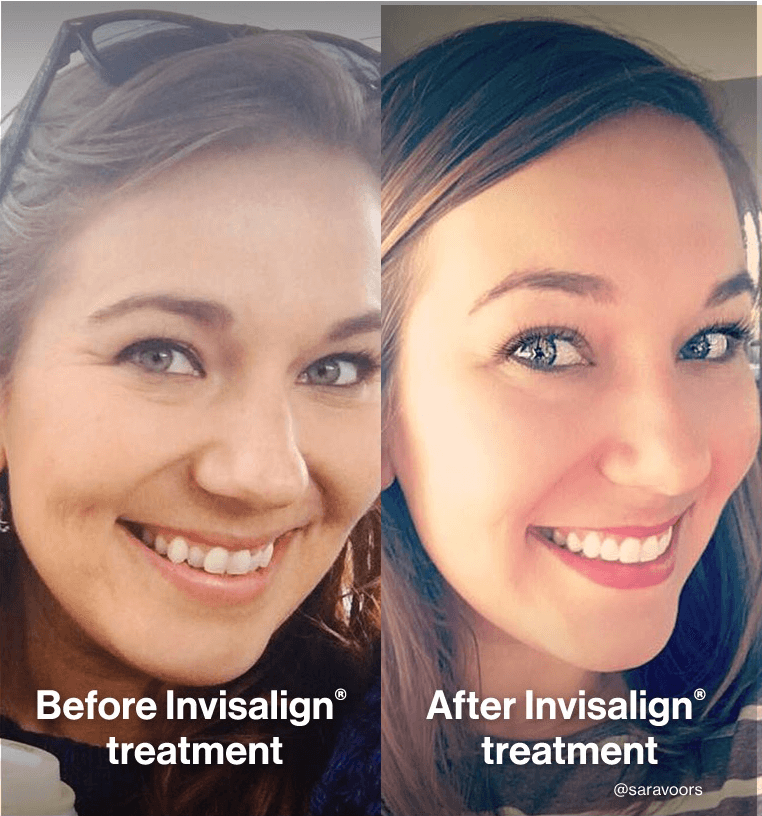 Invisalign SmileView